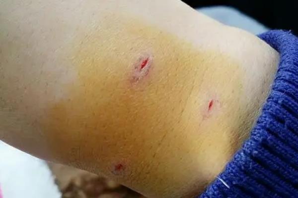 被猫咬了怎么办，需要立刻清理伤口