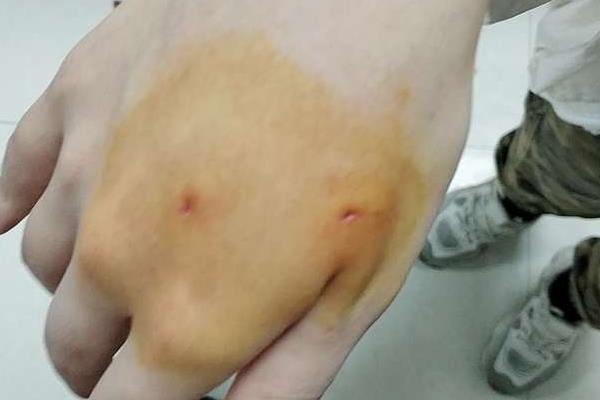 被猫咬了怎么办，需要立刻清理伤口