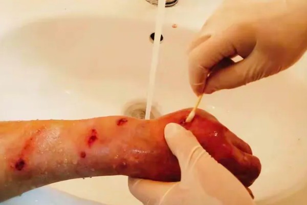 马蜂的毒性，可引发过敏反应