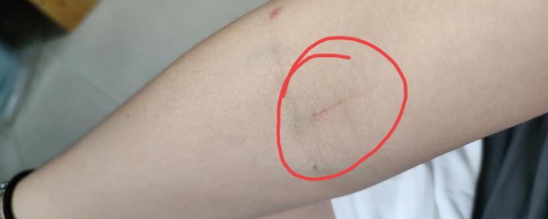 被猫抓了要打疫苗吗，注射狂犬疫苗能有效避免狂犬病发作