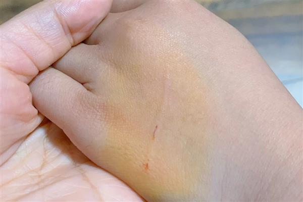 被猫抓了要打疫苗吗,注射狂犬疫苗能有效避免狂犬病发作