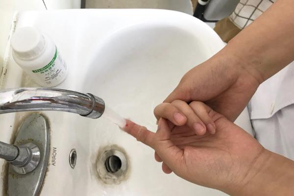 蜜蜂蛰了如何处理，第一步就是拔出刺