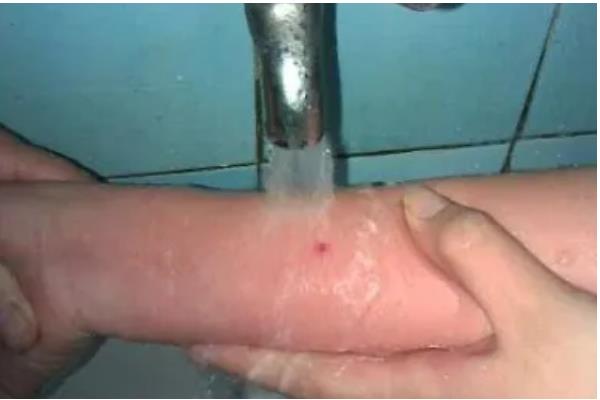 被马蜂蛰了怎么处理，应当快速远离蜂巢并清洗伤处