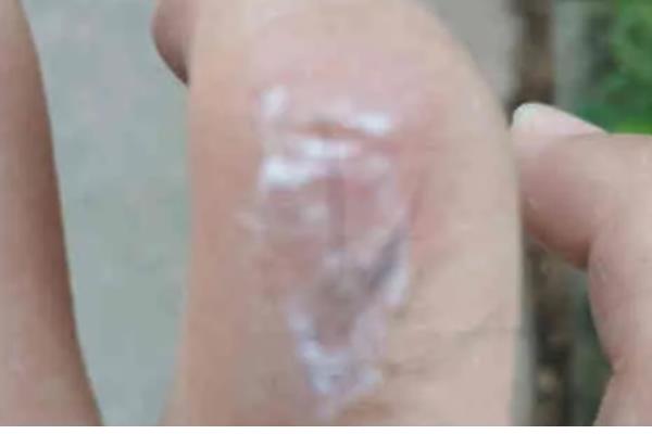 被马蜂蛰了怎么处理，应当快速远离蜂巢并清洗伤处