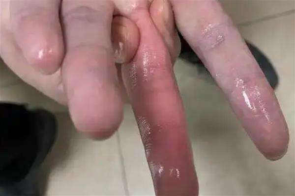 被蜈蚣咬了怎么处理，先用肥皂水清洗伤口