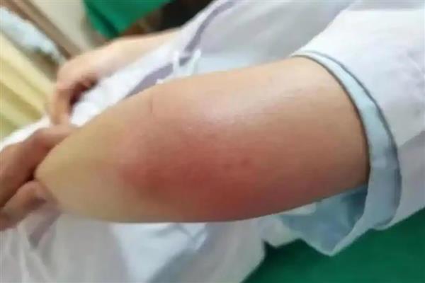 被蜈蚣咬了怎么处理，先用肥皂水清洗伤口