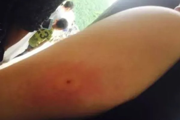 被马蜂蜇了怎么办,用弱酸性溶液冲洗被蛰处并涂抹解毒药物