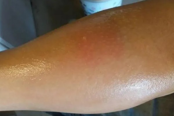 被马蜂蜇了怎么办,用弱酸性溶液冲洗被蛰处并涂抹解毒药物