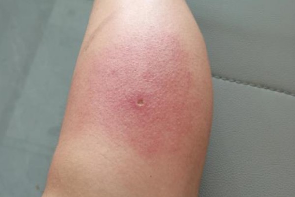 被马蜂蜇了怎么办,用弱酸性溶液冲洗被蛰处并涂抹解毒药物
