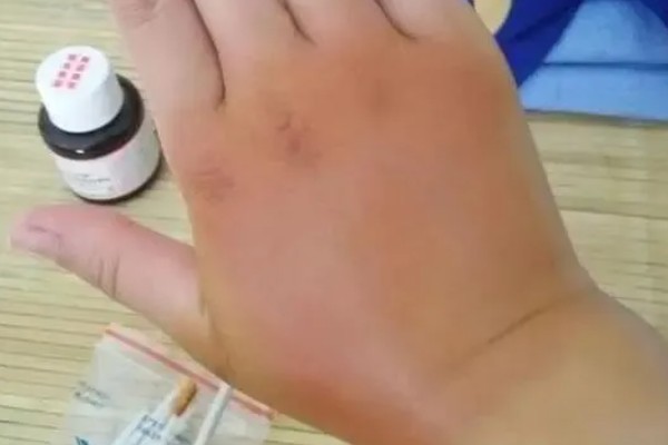 被马蜂蜇了怎么办,用弱酸性溶液冲洗被蛰处并涂抹解毒药物